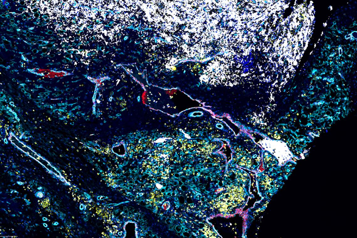 Neuroblastoma imaging showing cancer cells (white), immune cells supportive tissue and blood vessels.
